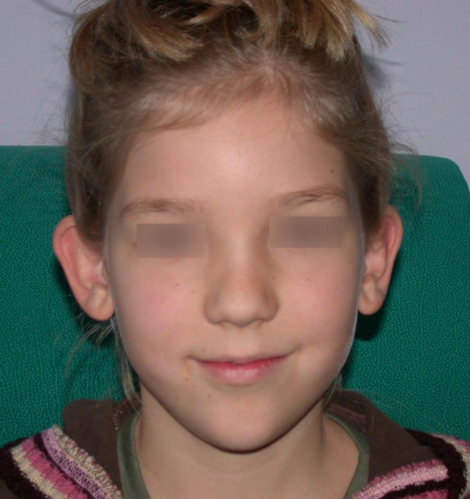 Before-Korekcija ušiju