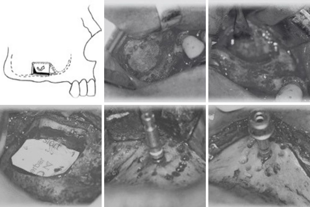 Sinus lift - Zubni implanti - Beograd centar 2