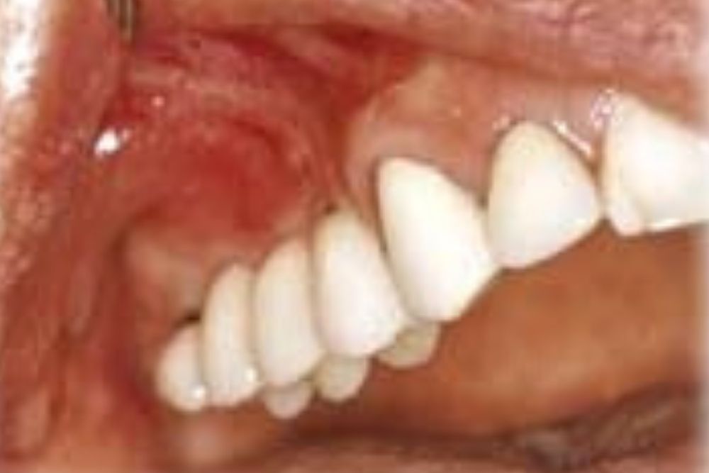 Sinus lift - Zubni implanti - Beograd centar 4