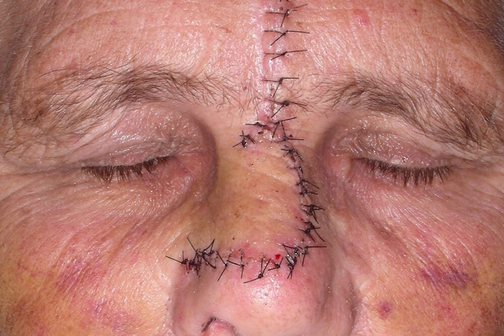 maksilofacijalna hirurgija tumori kože lica beograd centar 3