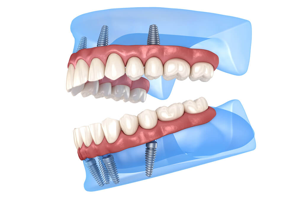 zubna proteza na implantima beograd centar 1
