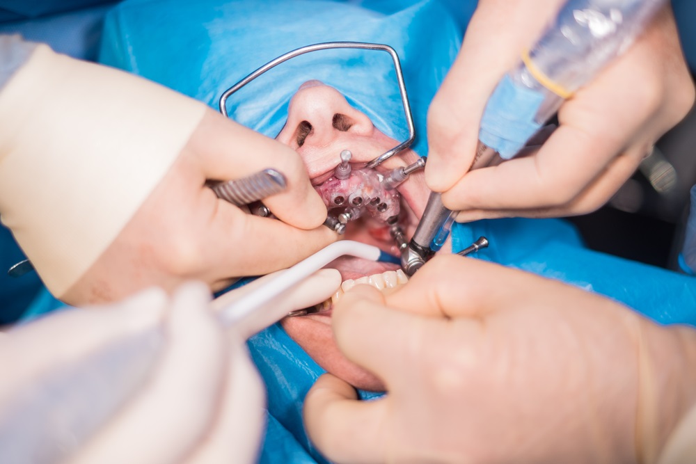 kako se ugrađuju zubni implanti beograd centar 1