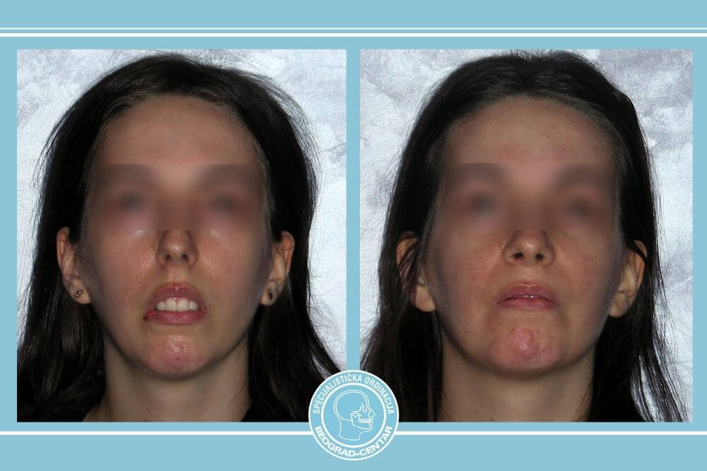 sindrom dugog lica beograd centar 2
