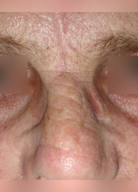 After-Tumori kože lica i poglavine 