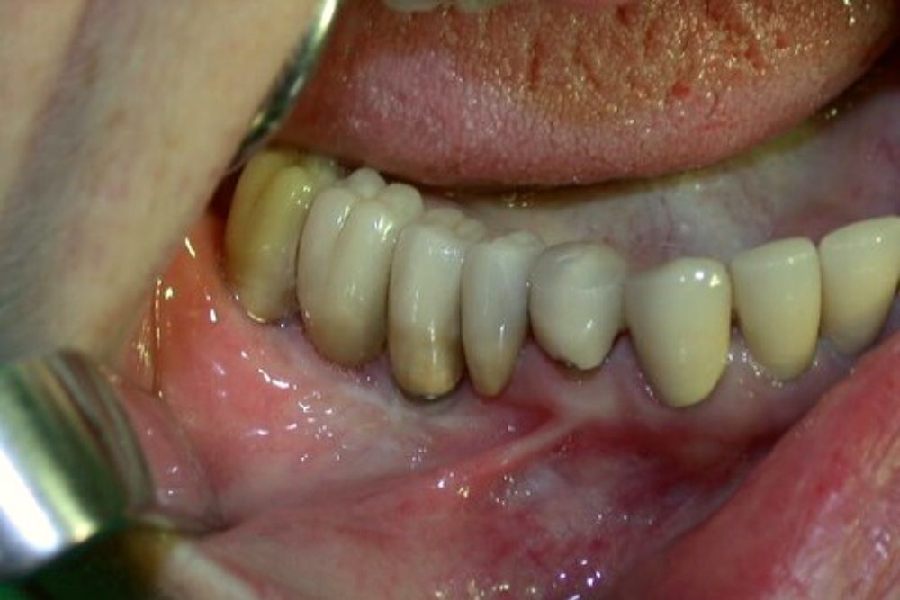 Laterizacija nerava - Zubni implanti - Beograd Centar 3