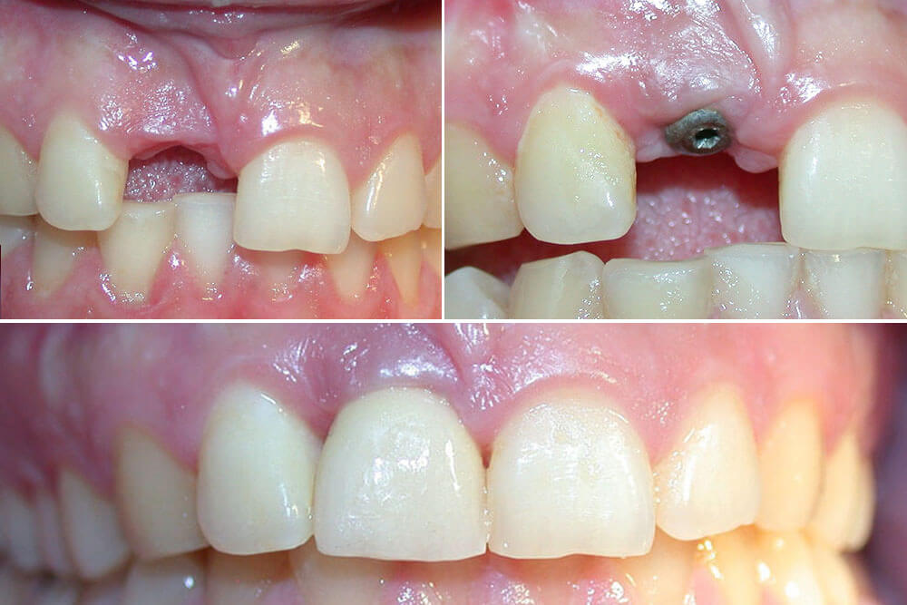 Zubni implanti - Nedostatak jednog zuba - Beograd Centar 2