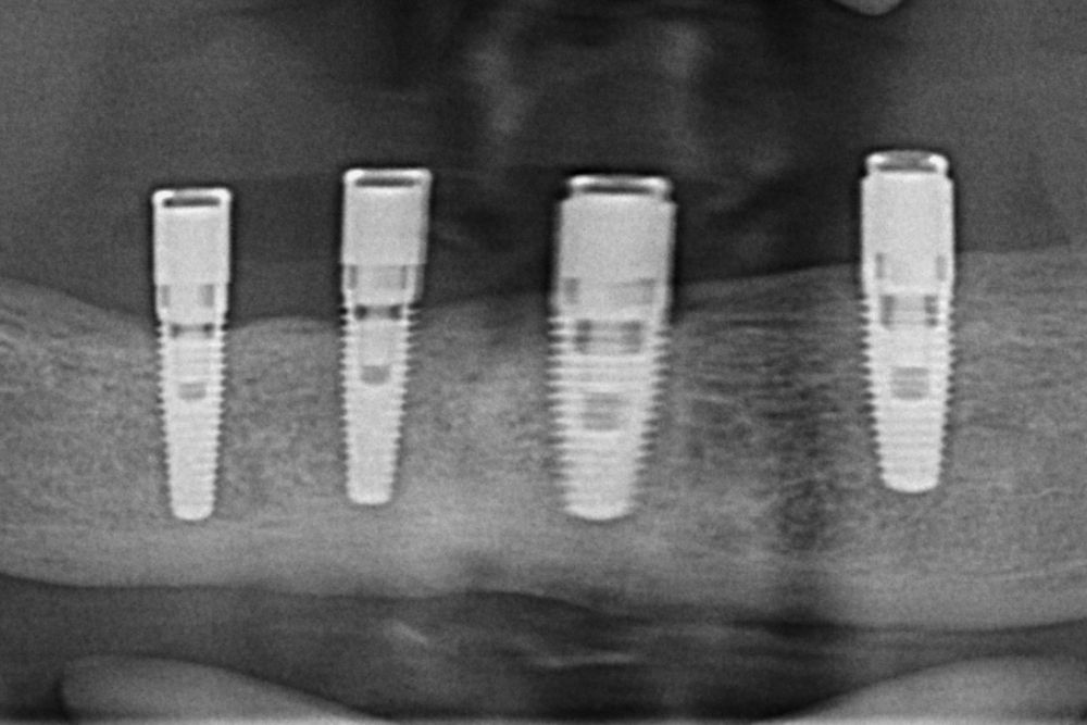Zubni implanti - Proteza na implantima - Beograd Centar 3