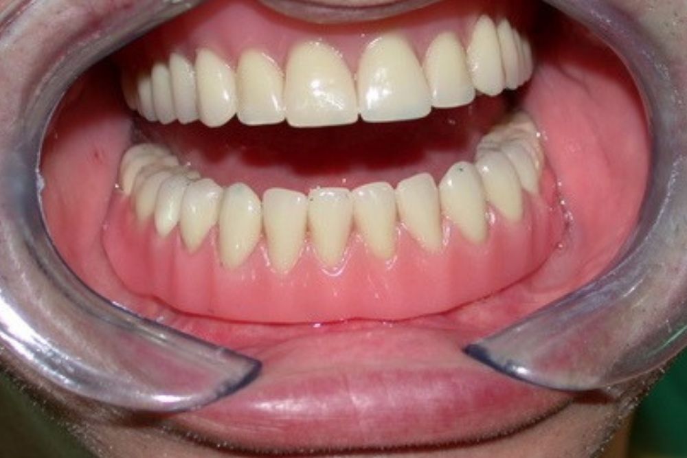 Zubni implanti - Proteza na implantima - Beograd Centar 5