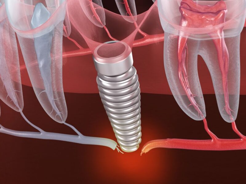 odbacivanje implantata simptomi beograd centar 1