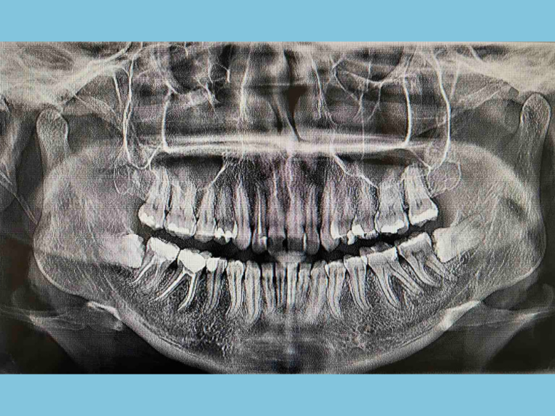 hirursko-vadjenje-duboko-impaktiranih-umnjaka