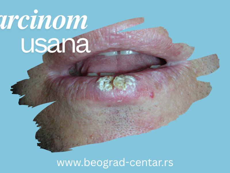 karcinom-usne