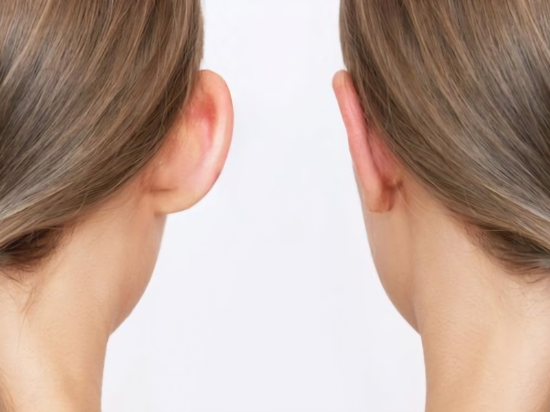 operacija-ušiju-otoplastika